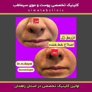 تزریق فیلر