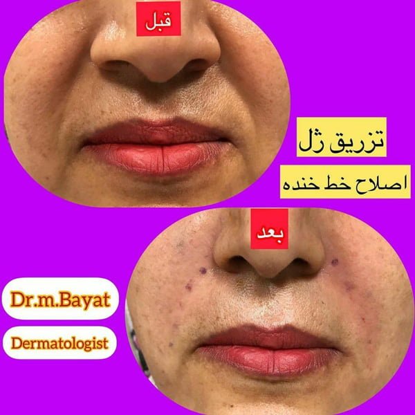 تزریق ژل در زاهدان