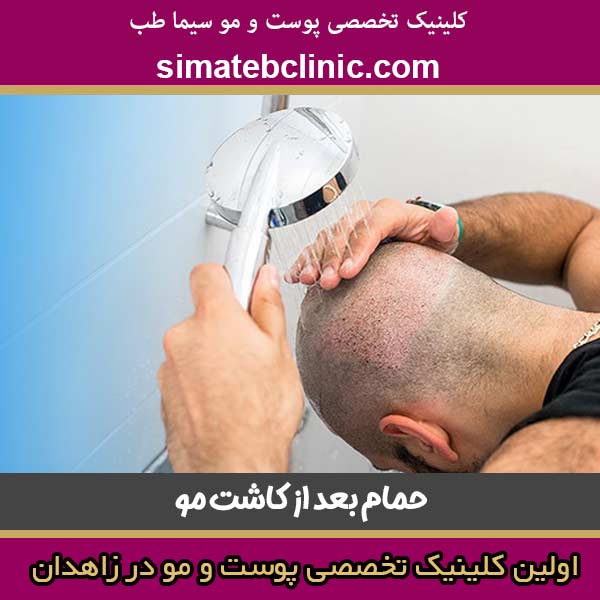 حمام بعد از کاشت مو - کلینیک پوست و مو سیماطب زاهدان - دکتر موسی بیات