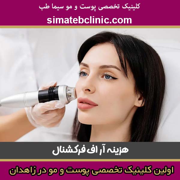 هزینه آر اف فرکشنال