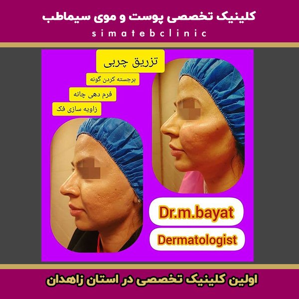 تزریق چربی به صورت