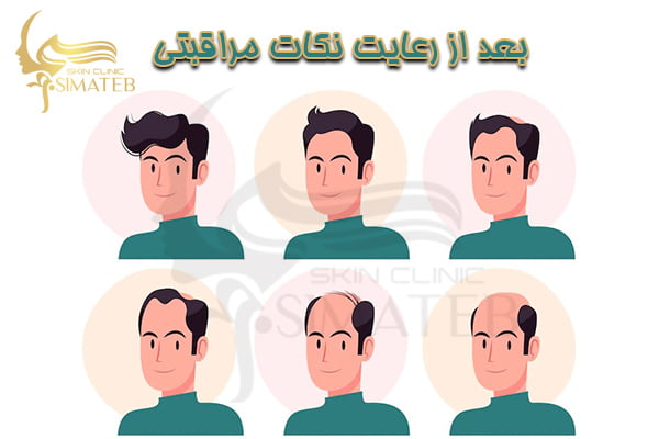 مراقبت های بعد از کاشت مو