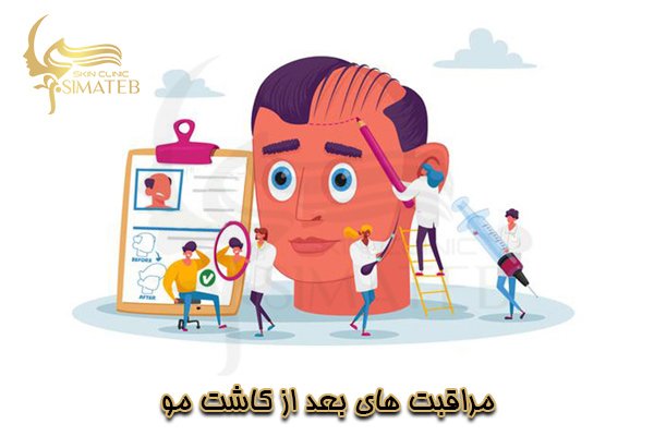 مراقبت های بعد از کاشت مو
