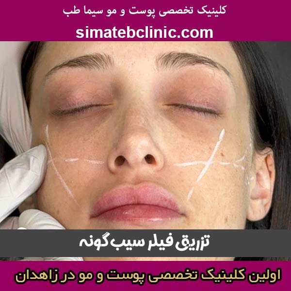 تزریق فیلر سیب گونه